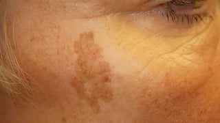 Dark spots after menopause? Here’s how to fade them naturally